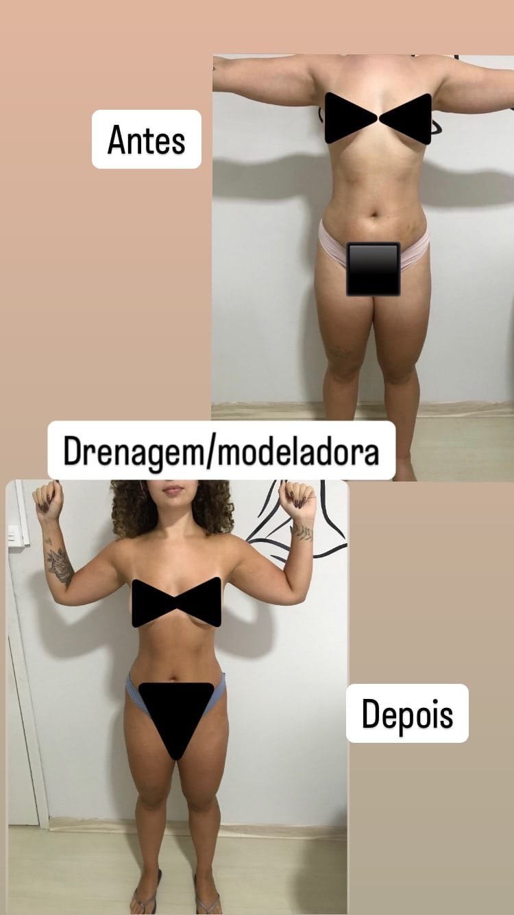 Antes e depois de drenagem linfática modeladora