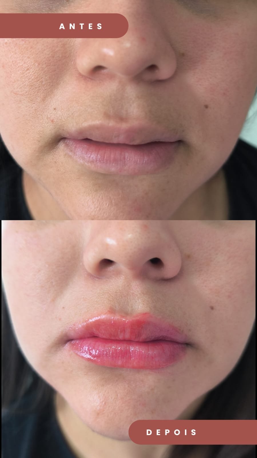 Antes e depois de hidragloss labial